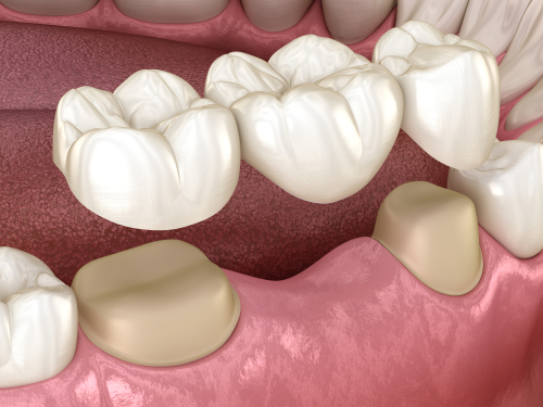 Dental Bridge in Temecula, CA | Book Your Free Consultation Today