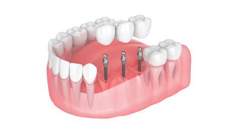 Dental Bridge in Temecula, CA | Restore Your Smile With Mini Implants