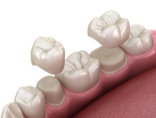 Same-Day Dental Crowns in Temecula, CA | Free Consultations