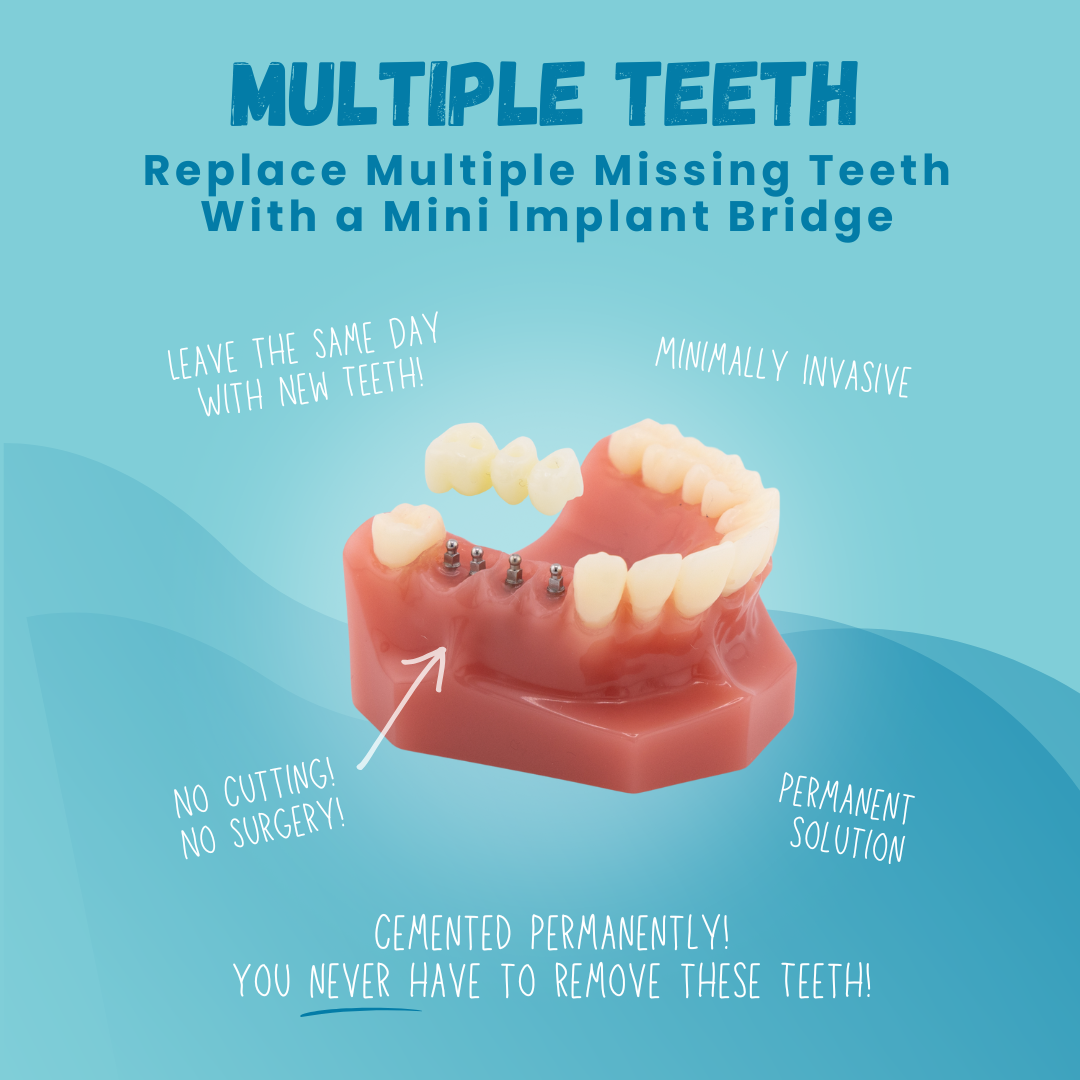 Reemplazo de múltiples dientes en Temecula
