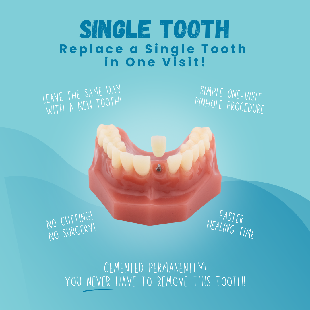 Reemplazo de un solo diente en Temecula