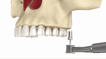 Sinus Lift in Temecula, CA | A Less Invasive Way To Restore Your Smile