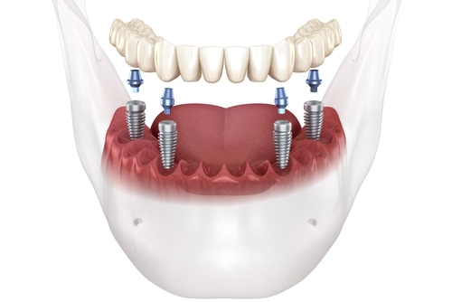 All-on-4 Dental Implant Alternatives | Mini Dental Implants in Temecula, CA