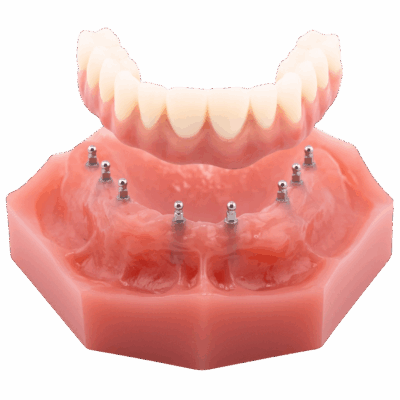 Same-Day Dentures in Temecula, CA | Book a Free Consultation