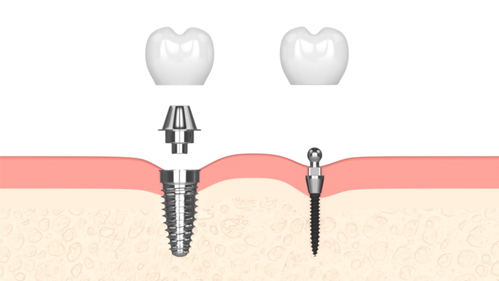 Best Implant Options in 2026 [Video Explanation] Free Consultation