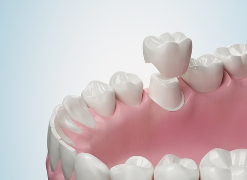 Coronas CEREC en Temecula, California [Vídeo incluido] | Consulta gratuita
