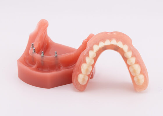 Prótesis dentales removibles | Opciones de implantes a precios accesibles en Temecula, California