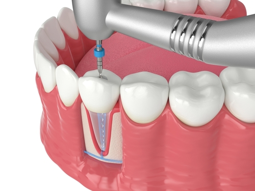 Root Canal Treatment [Video Q&A] | Free Consultation in Temecula