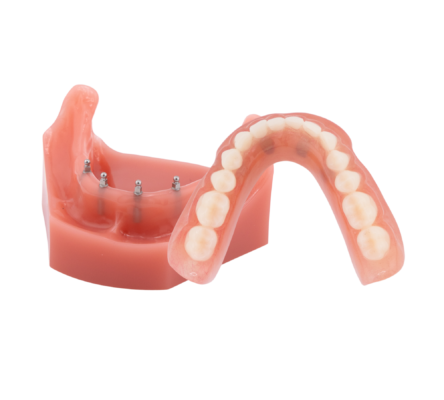 Snap-In Dentures [Video Walkthrough] | Stabilize Your Smile With Dental Implants