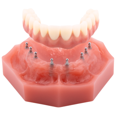 Denture Alternatives [Video Explanation] Free Implant Consultation