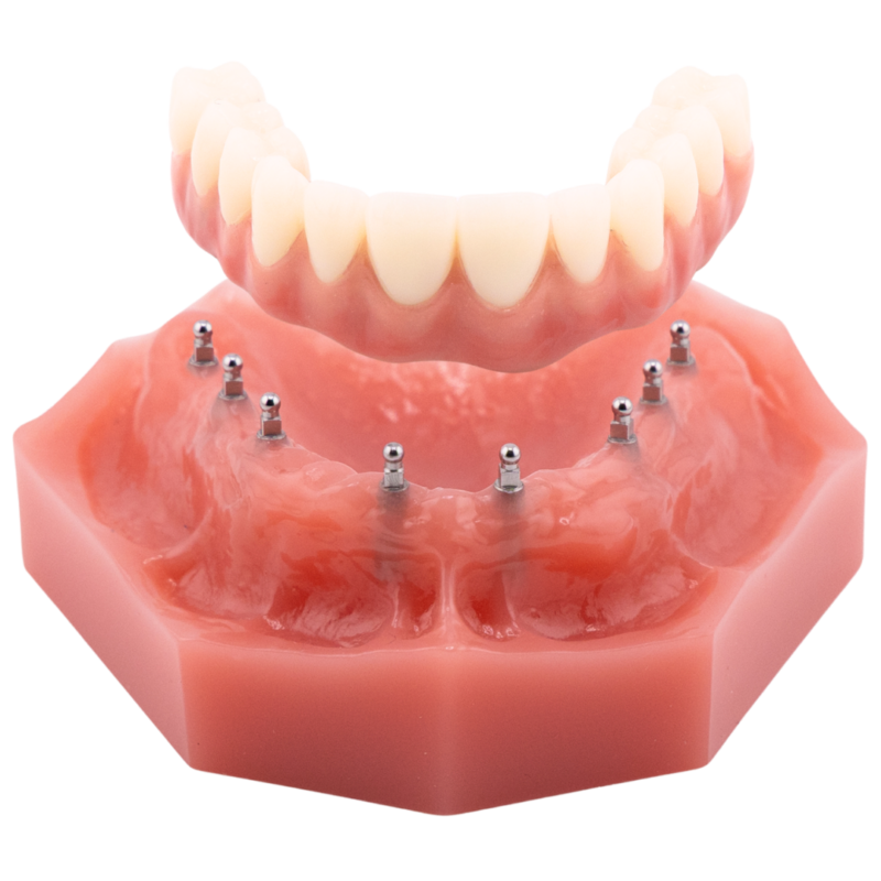 Denture Alternatives [Video Explanation] Free Implant Consultation