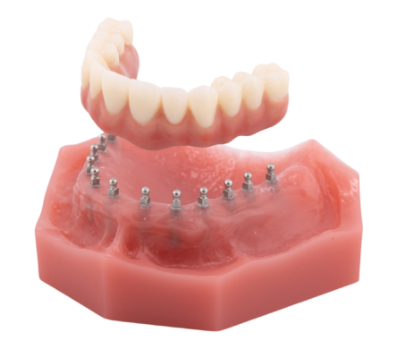 Denture Alternatives [Video Explanation] | Implant Denture Restorations