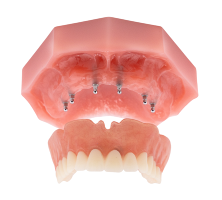 Denture Alternatives [Video Explanation] | Secure Your Smile With Dental Implants