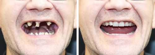Full Mouth Restoration in Temecula, CA | Completely Restore Your Smile