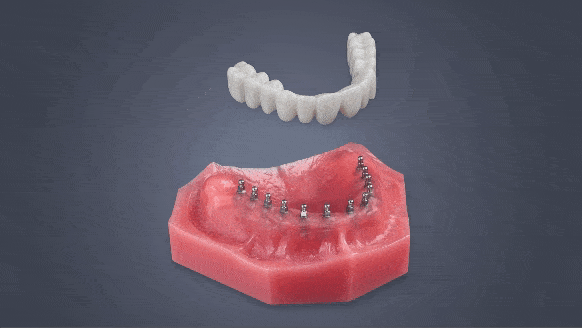 Permanent Dentures in Temecula, CA | Permanent Roundhouse Bridge