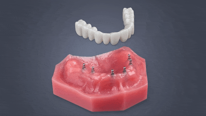 Permanent Dentures in Temecula, CA | Semi-Permanent Roundhouse Bridge