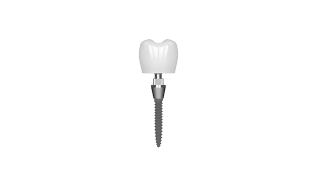 Missing Teeth in Temecula, CA | Book a Free Consultation Today!